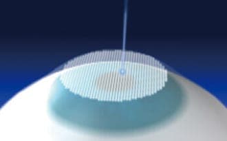 使用Zyoptix XP板層刀切削角膜瓣